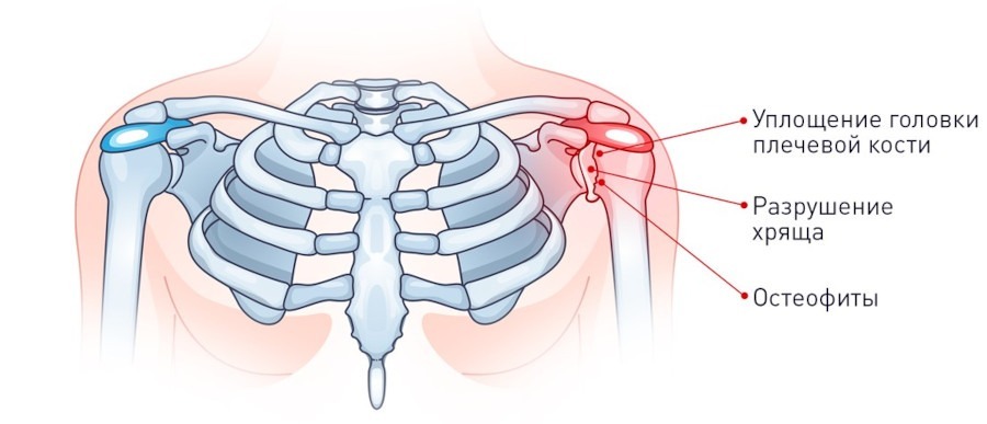 Артроз плечевого сустава: симптомы, степени и лечение4