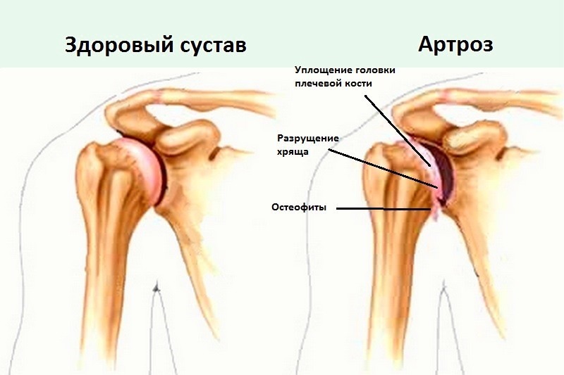 Артроз плечевого сустава: симптомы, степени и лечение3