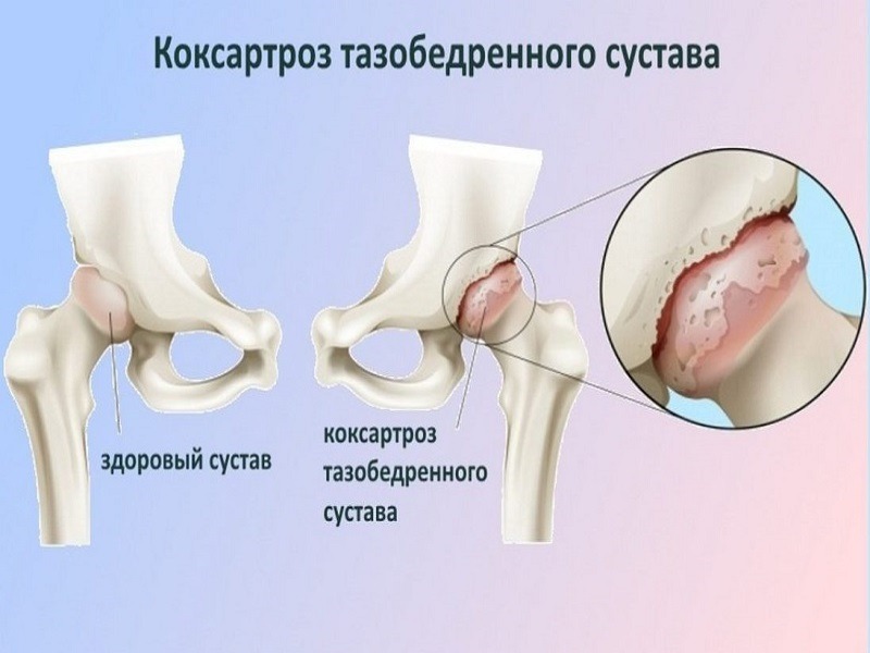 Коксартроз (артроз тазобедренных суставов): симптомы и лечение3